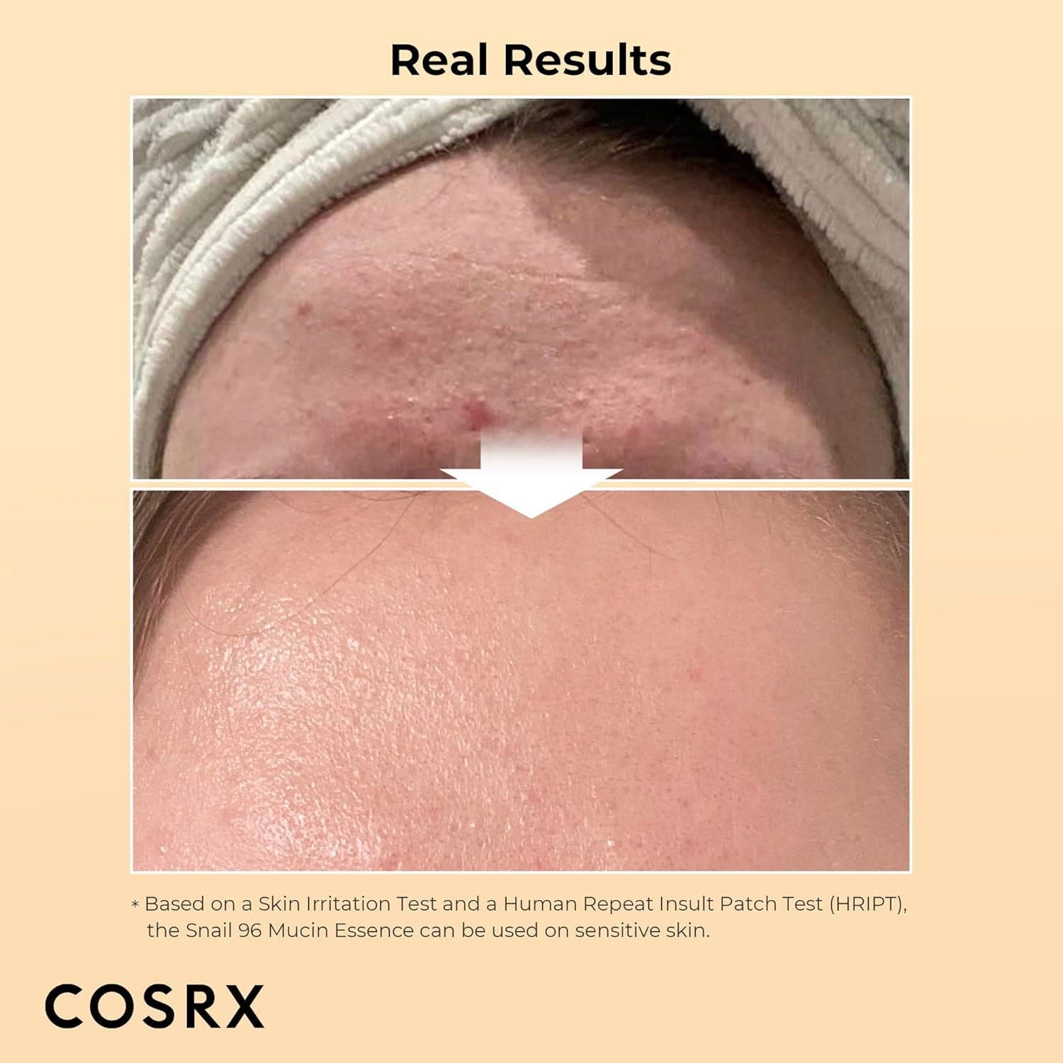 COSRX Combo Advanced Snail 96 Mucin Power Essence Face Moisturizers 100ml + Acne Pimple Patch 1 Pack (24 Count) - THE BEAUTY HEAVEN